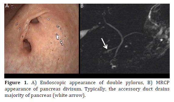 pancreas-endoscopic-appearance