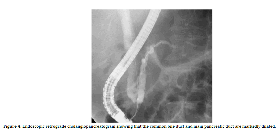 pancreas-endoscopic-cholangiopancreatogram