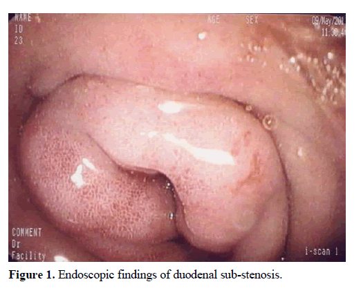pancreas-endoscopic-duodenal-sub-stenosis