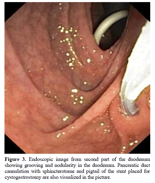 pancreas-endoscopic-duodenum-grooving