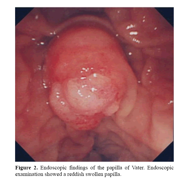 pancreas-endoscopic-findings-papilla