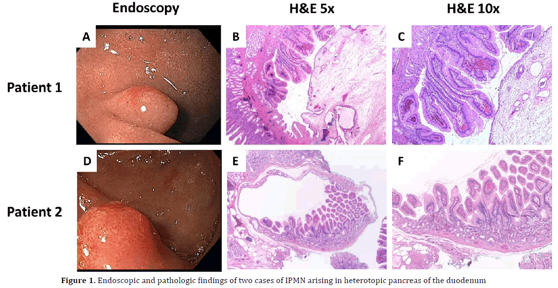 pancreas-endoscopic-pathologic-heterotopic