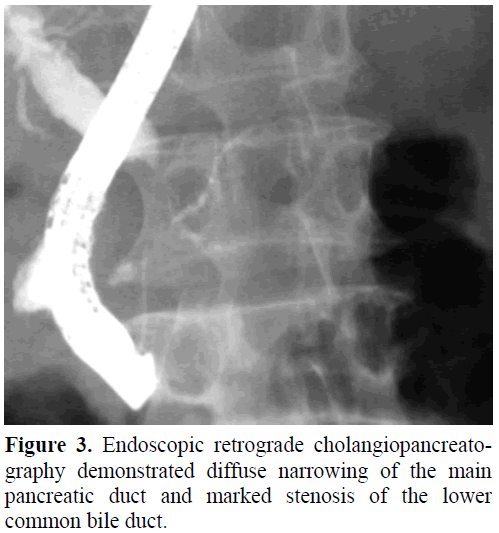 pancreas-endoscopic-retrograde