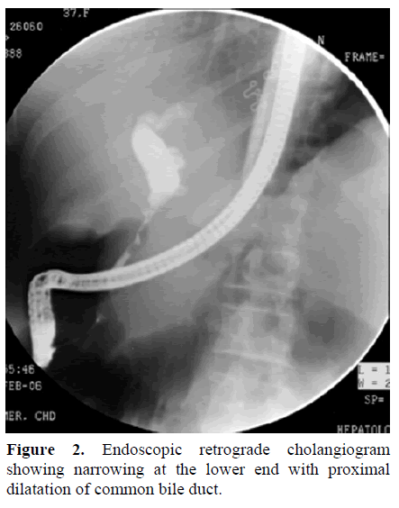 pancreas-endoscopic-retrograde-cholangiogram