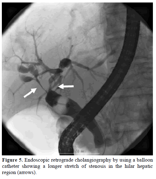 pancreas-endoscopic-retrograde-cholangiography