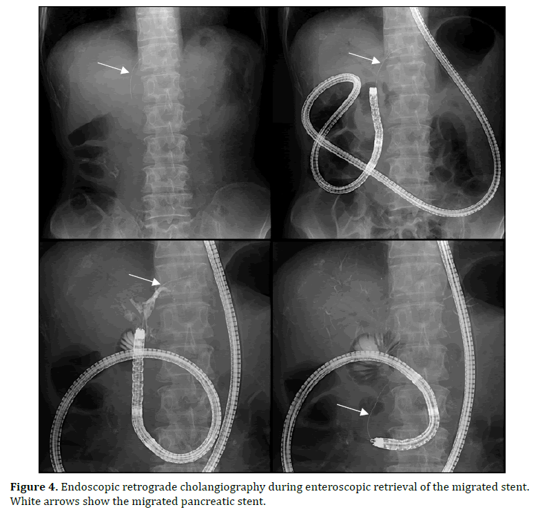 pancreas-endoscopic-retrograde-cholangiography