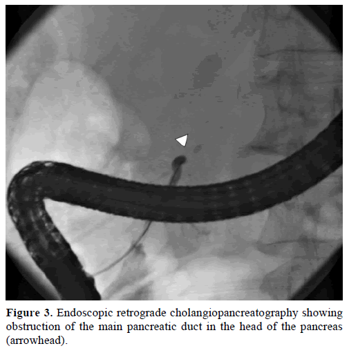 pancreas-endoscopic-retrograde-obstruction