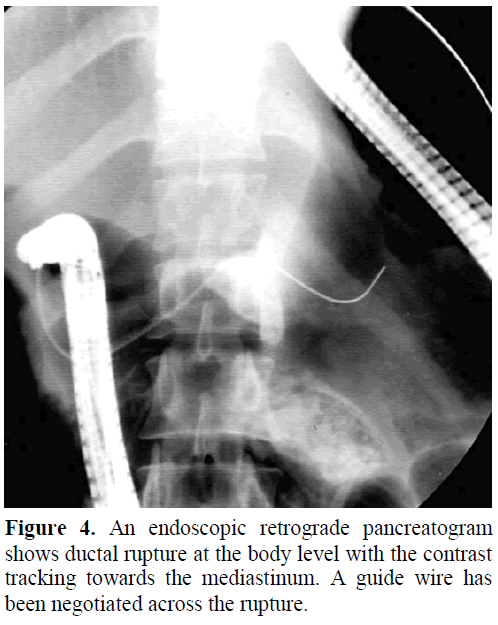 pancreas-endoscopic-retrograde-pancreatogram