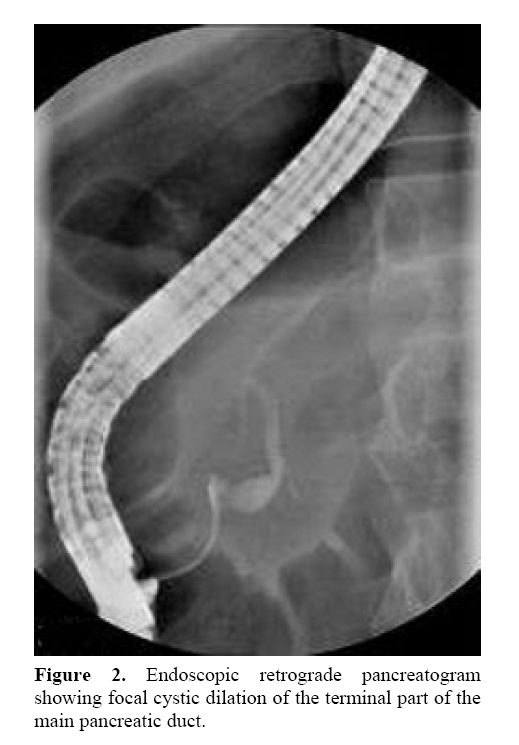 pancreas-endoscopic-retrograde-pancreatogram