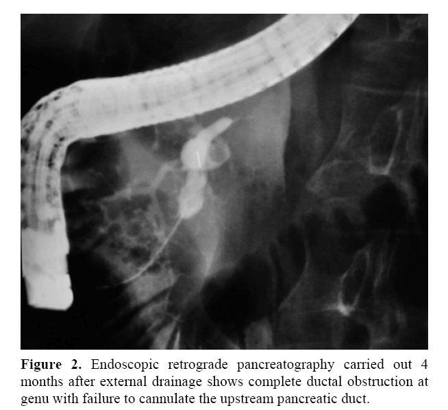 pancreas-endoscopic-retrograde-pancreatography