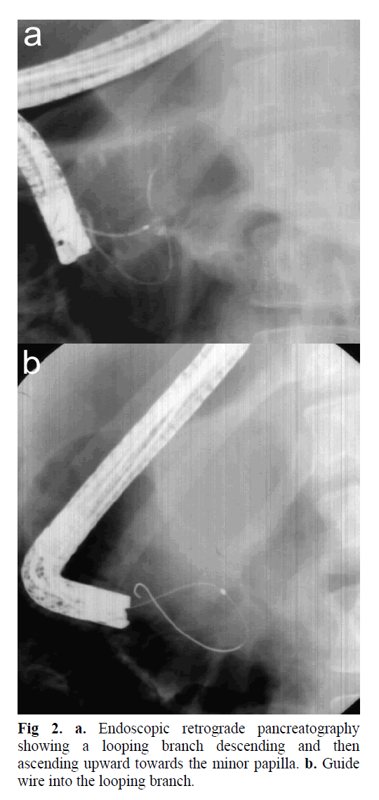 pancreas-endoscopic-retrograde-pancreatography