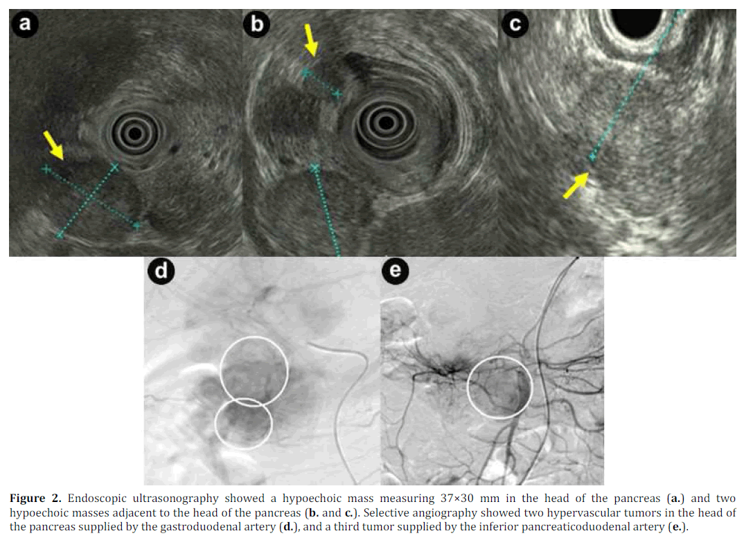 pancreas-endoscopic-ultrasonography