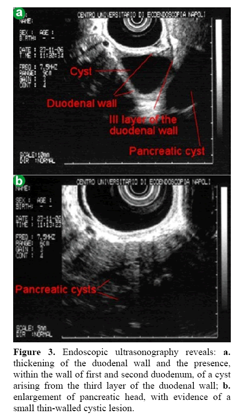 pancreas-endoscopic-ultrasonography