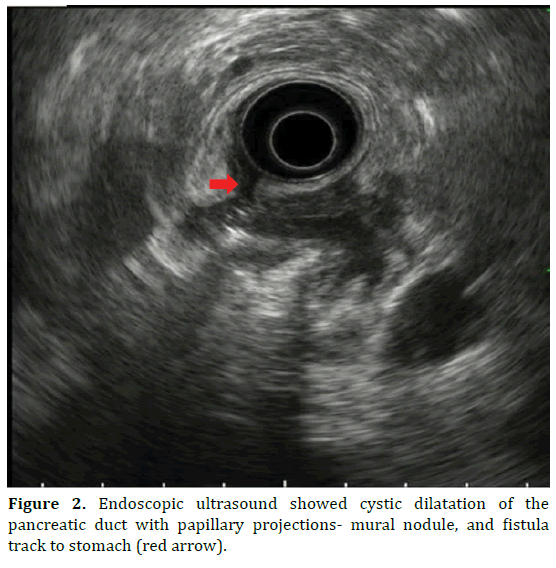 pancreas-endoscopic-ultrasound