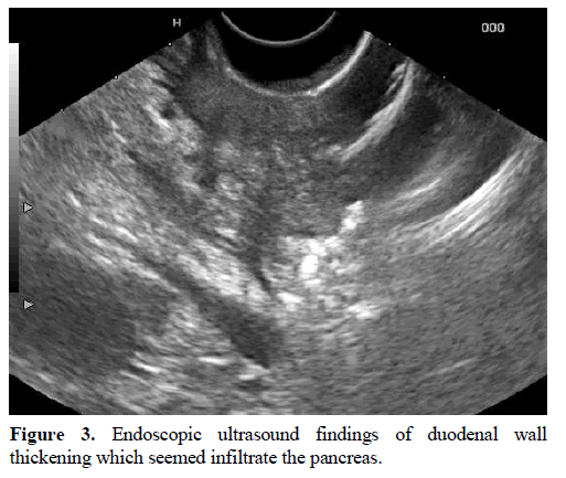 pancreas-endoscopic-ultrasound-duodenal-wall