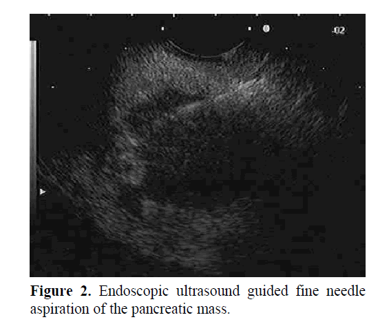 pancreas-endoscopic-ultrasound-guided