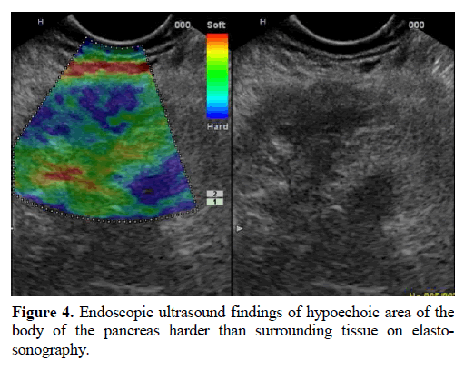 pancreas-endoscopic-ultrasound-hypoechoic