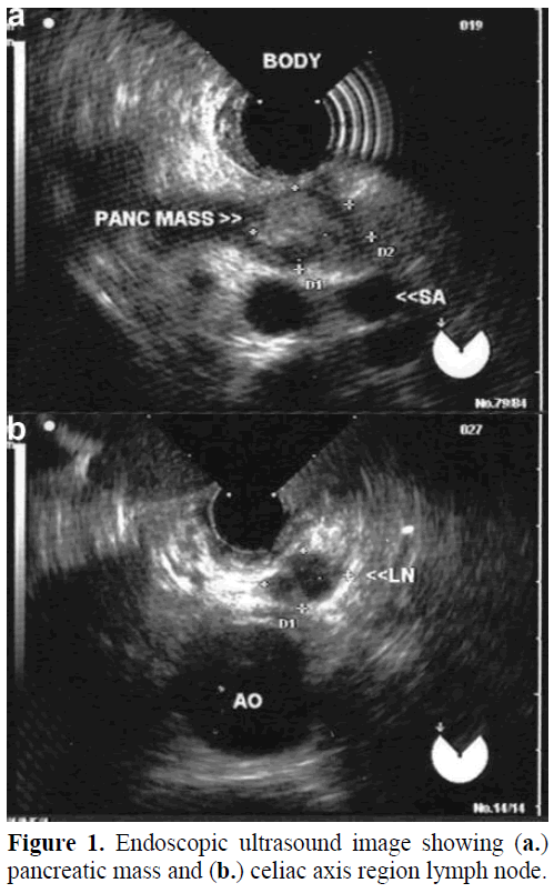 pancreas-endoscopic-ultrasound-image
