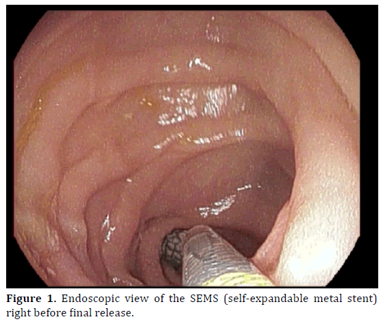 pancreas-endoscopic-view