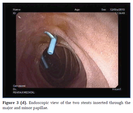 pancreas-endoscopic-view