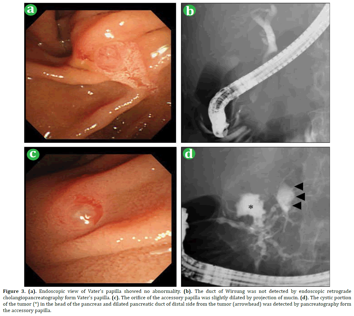 pancreas-endoscopic-view-Vaters