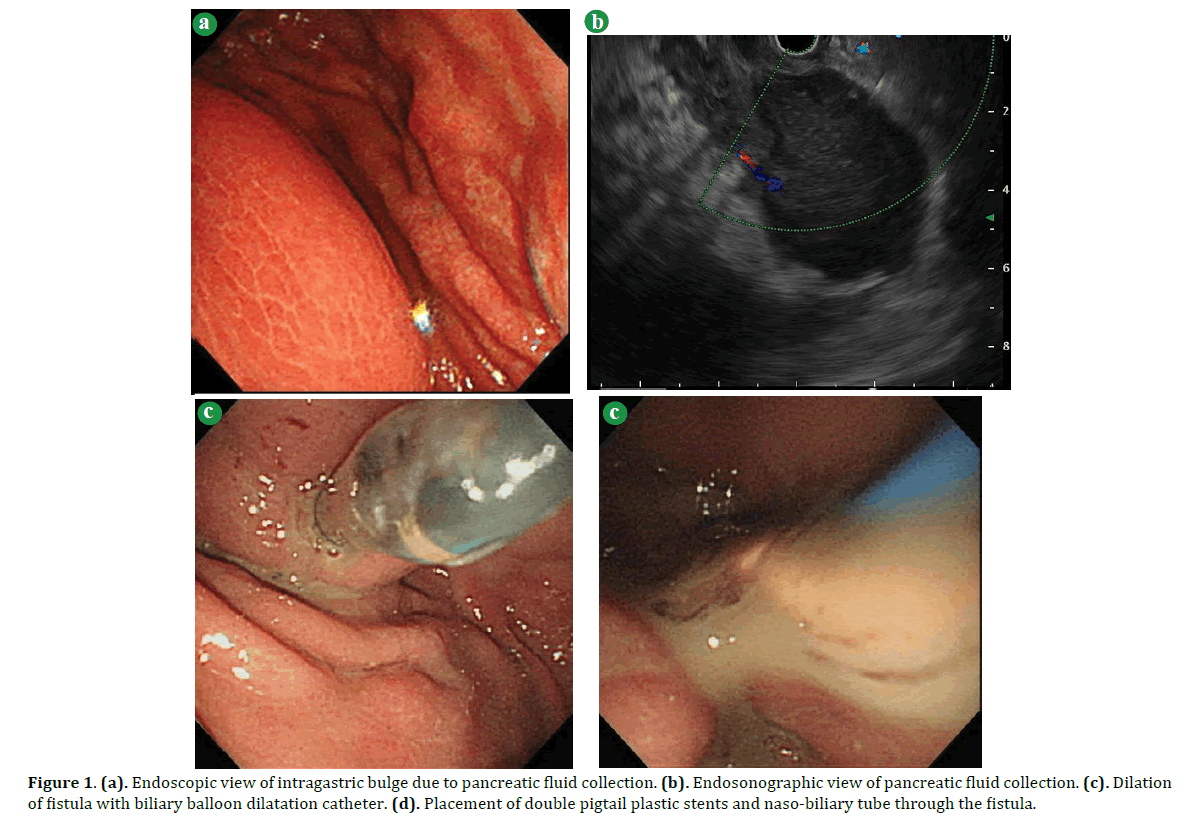 pancreas-endoscopic-view-intragastric-bulge