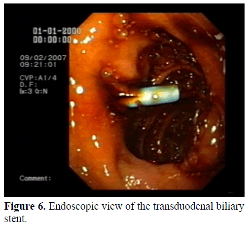 pancreas-endoscopic-view-transduodenal