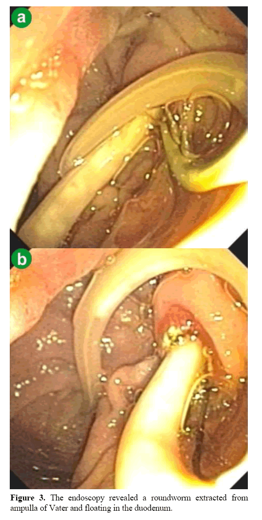 pancreas-endoscopy-revealed-roundworm