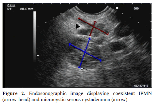 pancreas-endosonographic-image-coexistent2