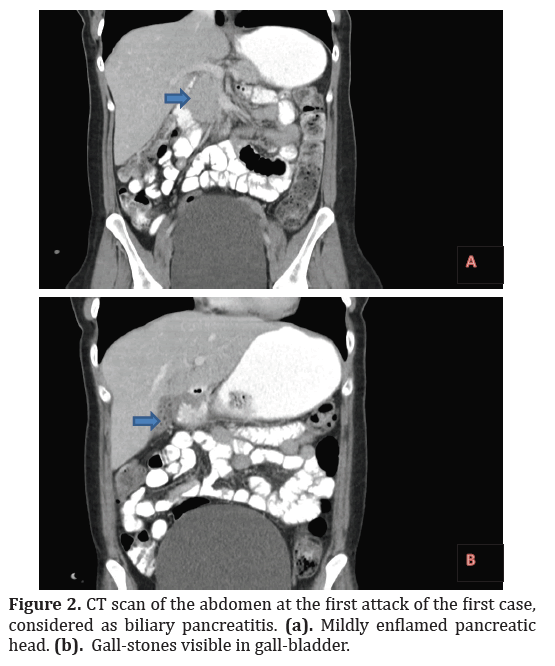 pancreas-enflamed-pancreatic