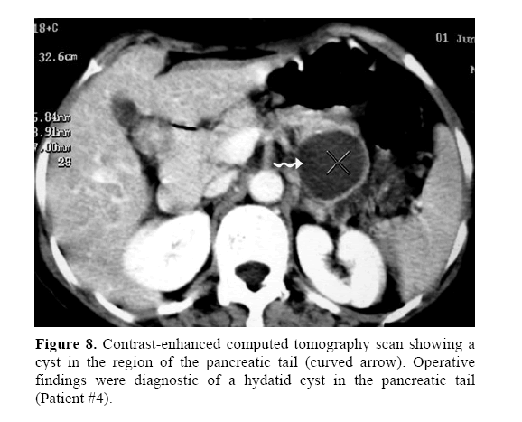 pancreas-enhanced-computed-tomography