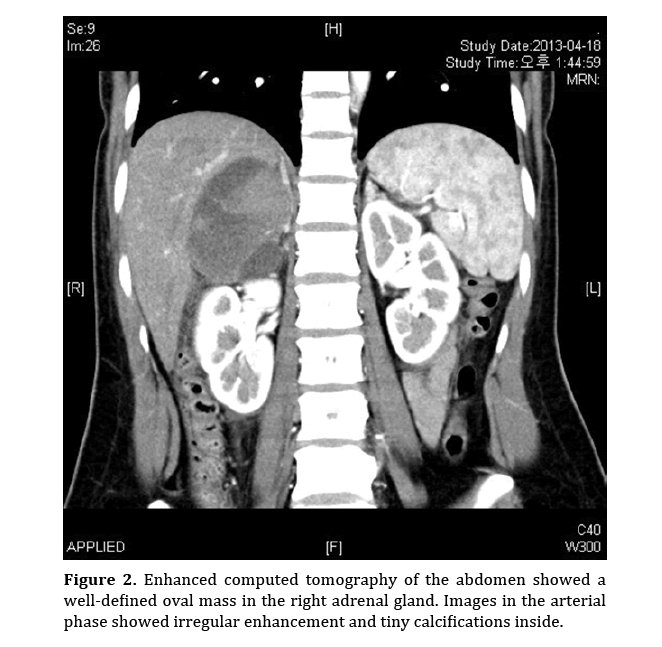 pancreas-enhanced-computed-tomography