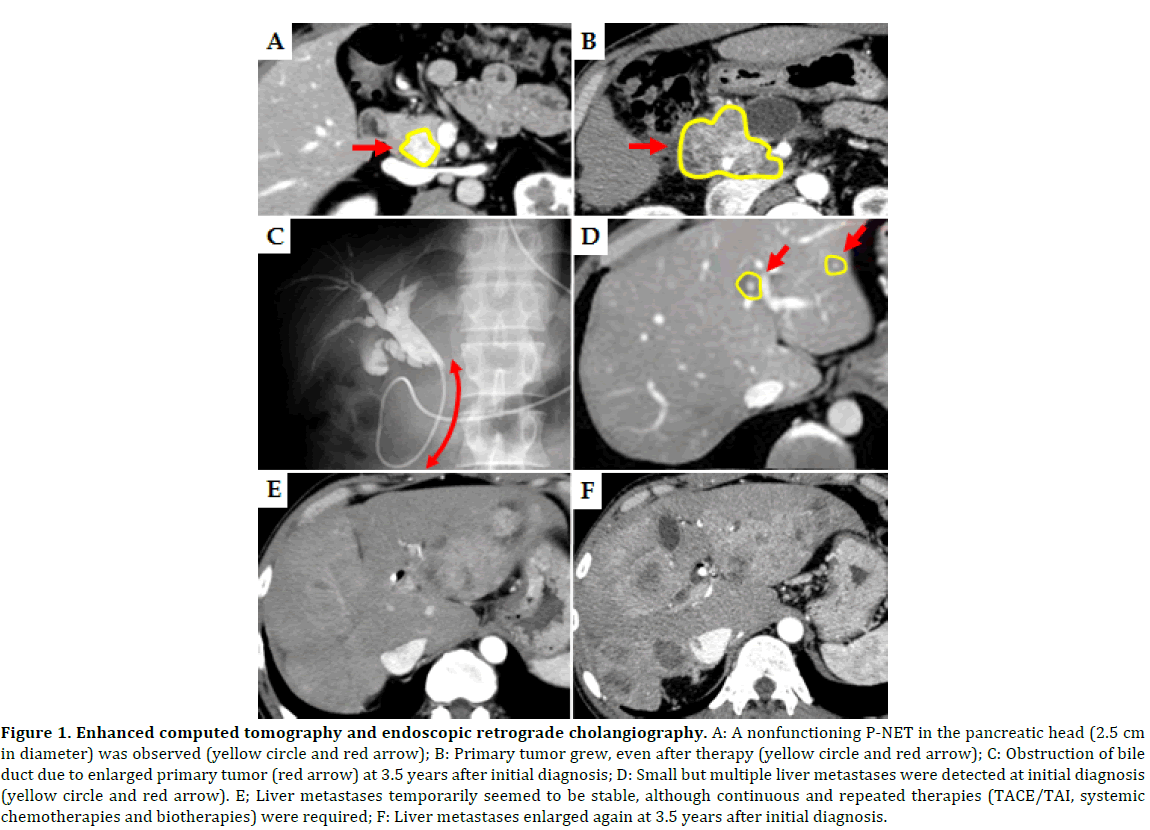 pancreas-enhanced-computed-tomography