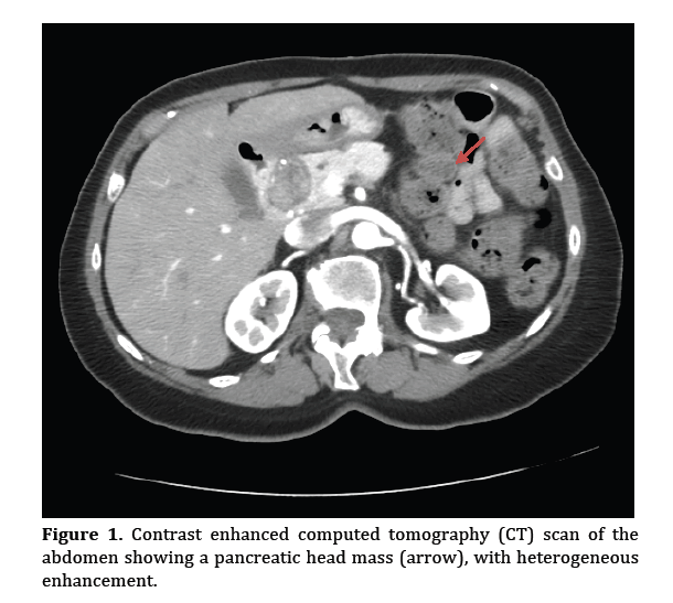 pancreas-enhanced-computed-tomography