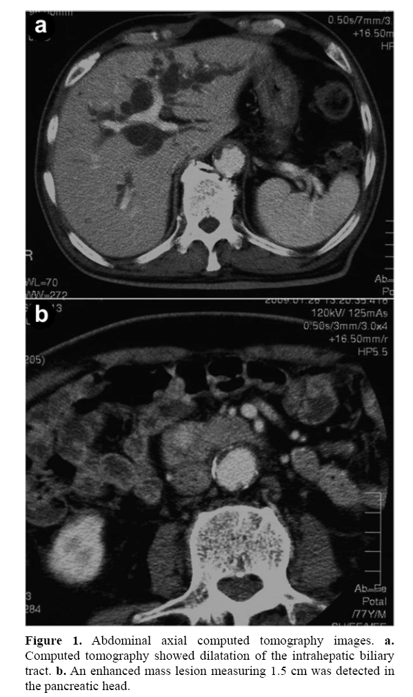 pancreas-enhanced-mass-lesion