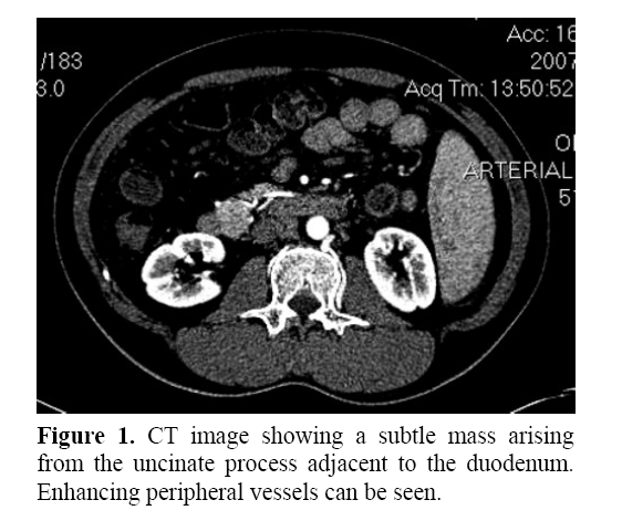 pancreas-enhancing-peripheral-vessels