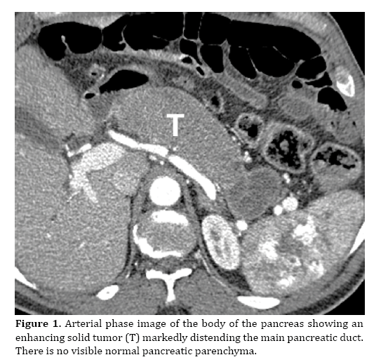 pancreas-enhancing-solid-tumor