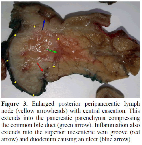 pancreas-enlarged-posterior-peripancreatic