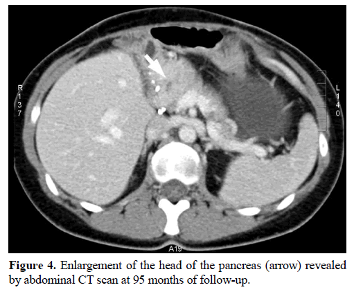 pancreas-enlargement-head-abdominal