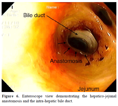 pancreas-enteroscope-view-demonstrating