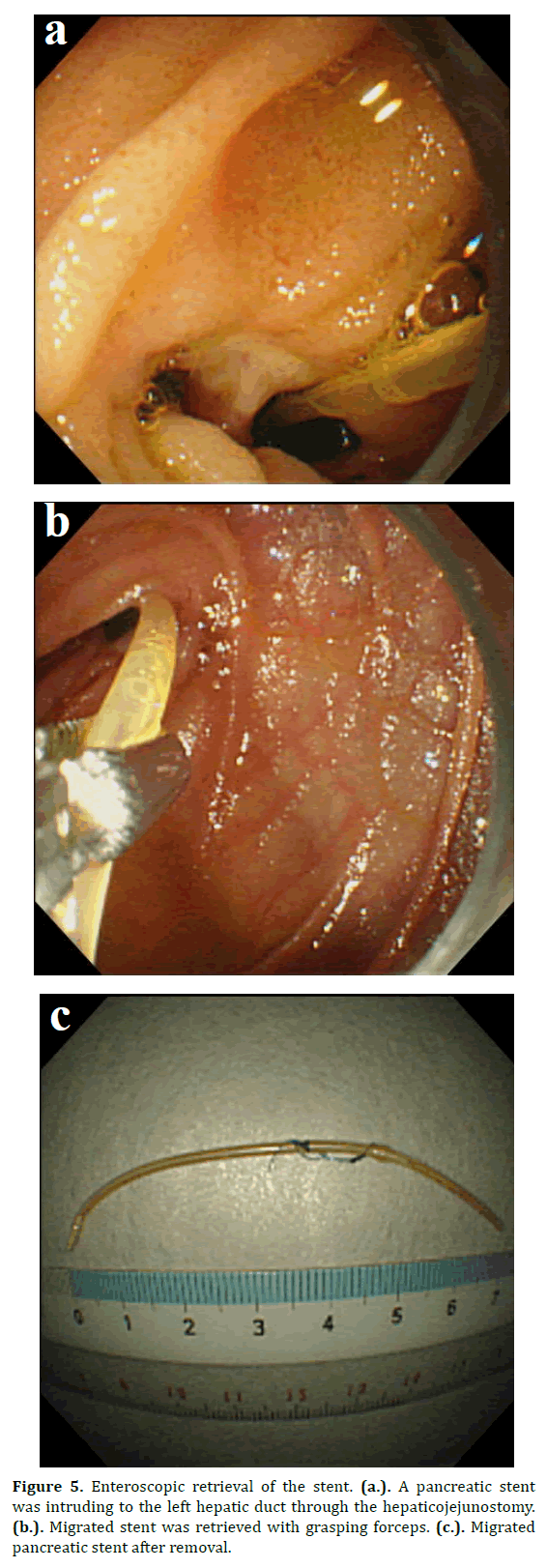 pancreas-enteroscopic-retrieval-stent
