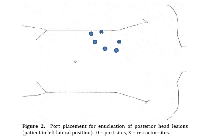 pancreas-enucleation-posterior