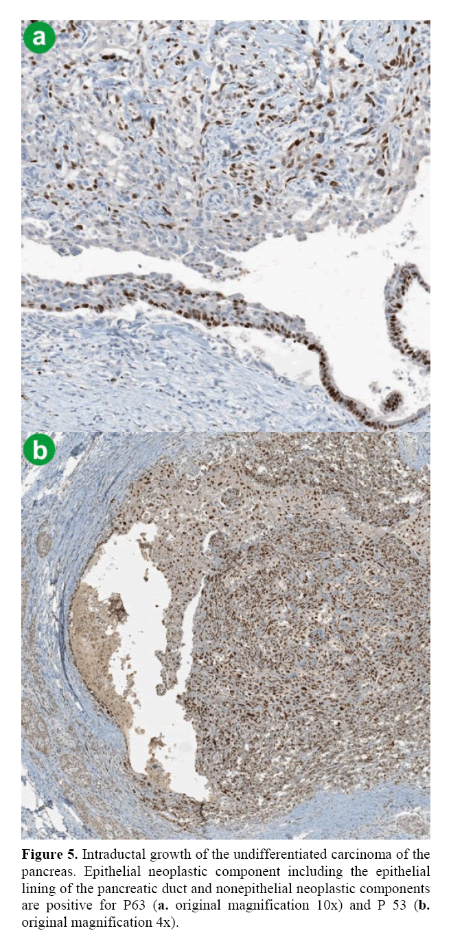 pancreas-epithelial-neoplastic-component