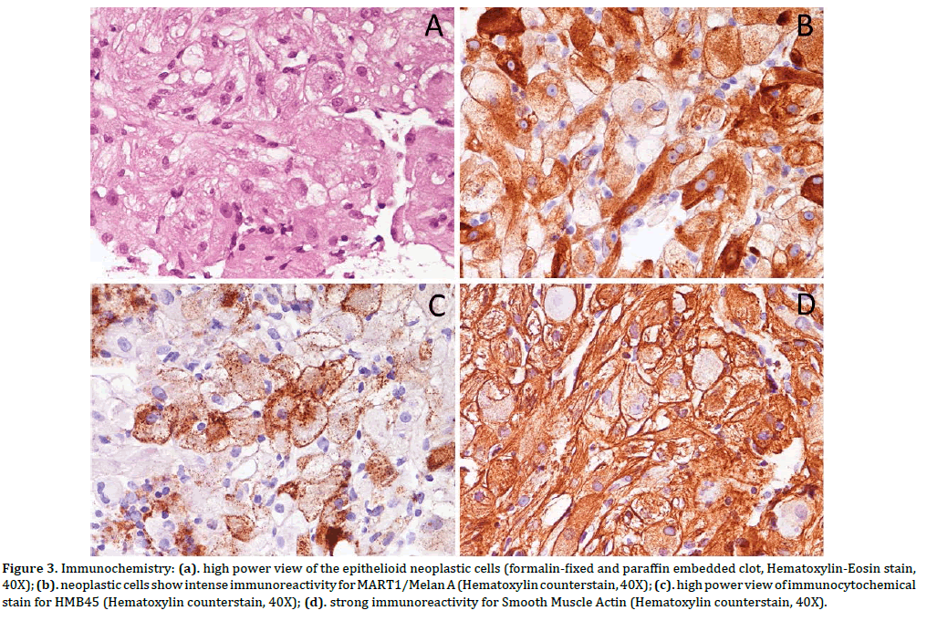 pancreas-epithelioid