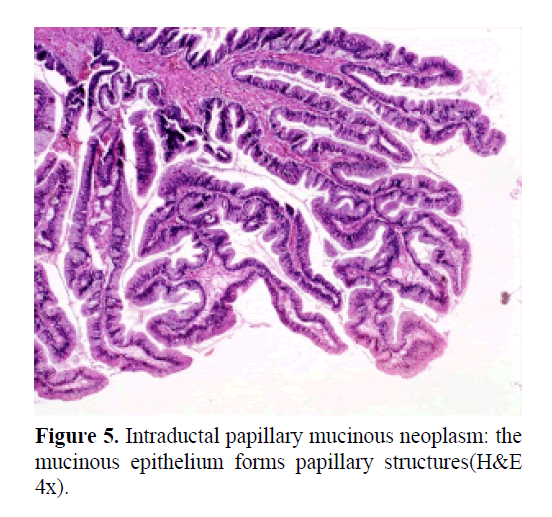 pancreas-epithelium-forms-papillary-structures