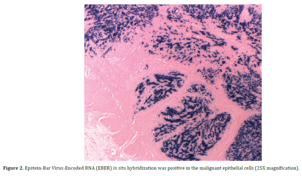 pancreas-epstein-bar-virus-