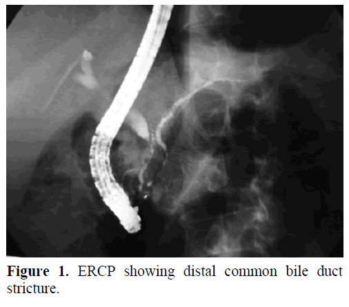 pancreas-ercp-distal-common-bile-duct