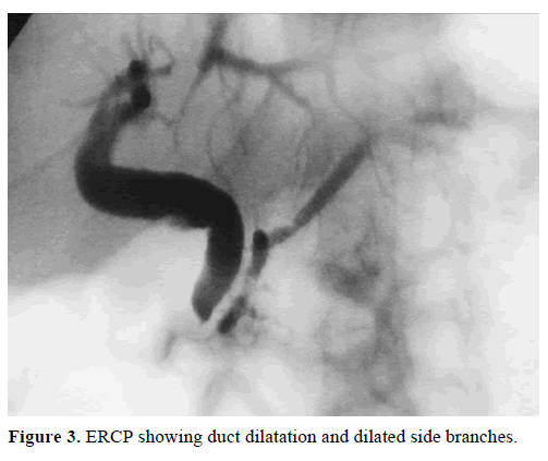 pancreas-ercp-duct-dilatation-branches