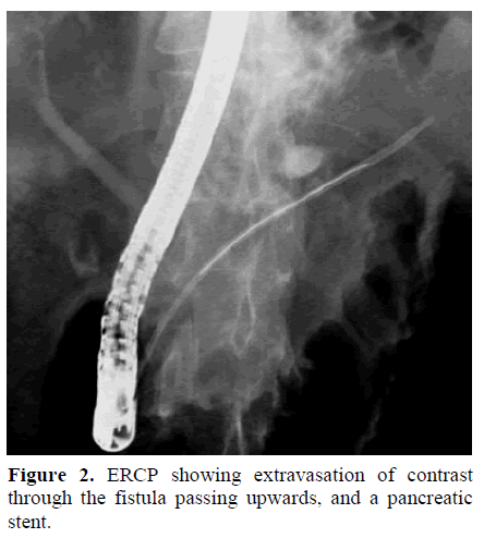 pancreas-ercp-extravasation-fistula