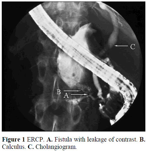 pancreas-ercp-fistula-leakage-contrast